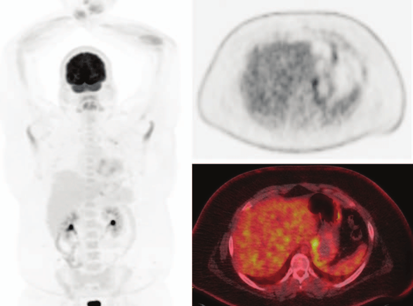 PET-CT-scan-1-year-after-resection-Disease-free-state-CT-computed-tomography-PET