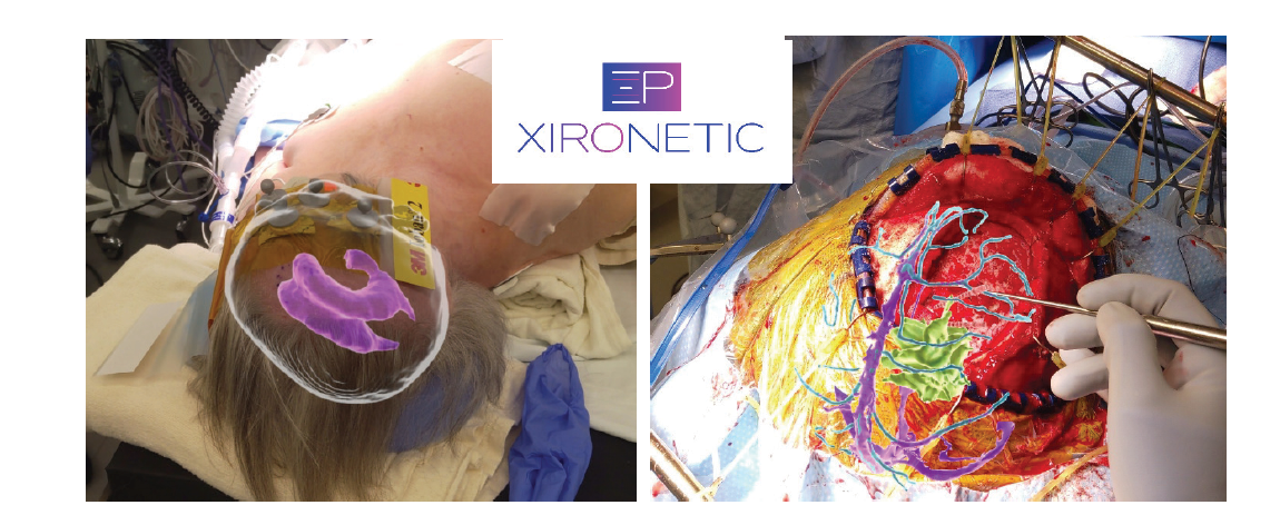 Xironetic_figure